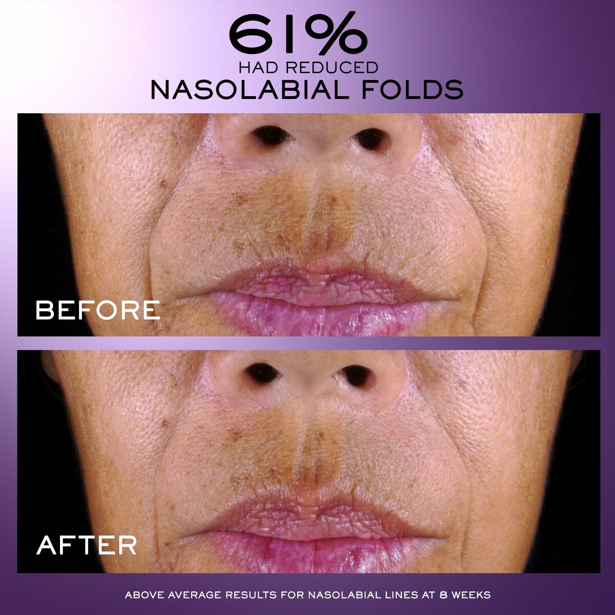Before and after results showing 61% reduction in nasolabial folds after 8 weeks of treatment.