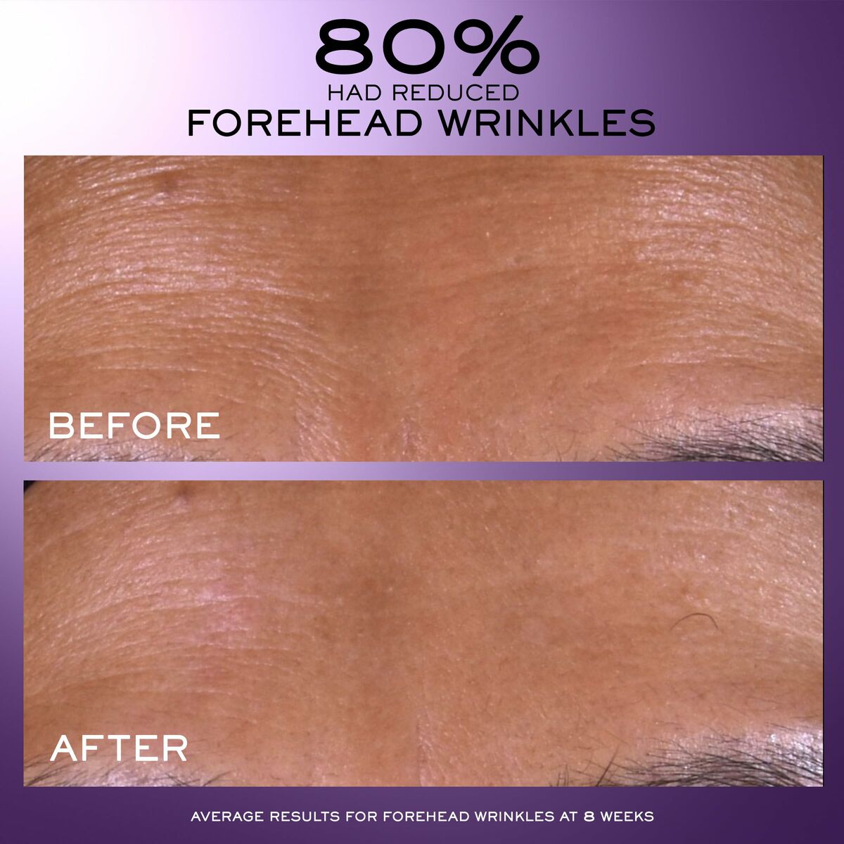 Before and after images showing reduced forehead wrinkles, highlighting 80% reduction in 8 weeks.